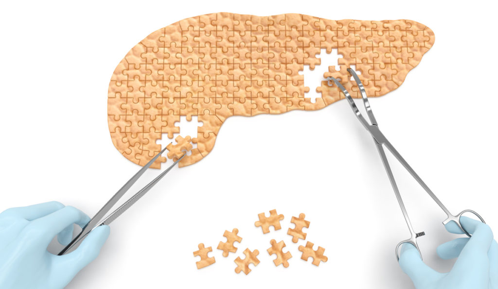 Cura del tumore del pancreas: studio italiano suggerisce nuove linee-guida (specie negli anziani)