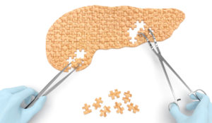 tumore_pancreas