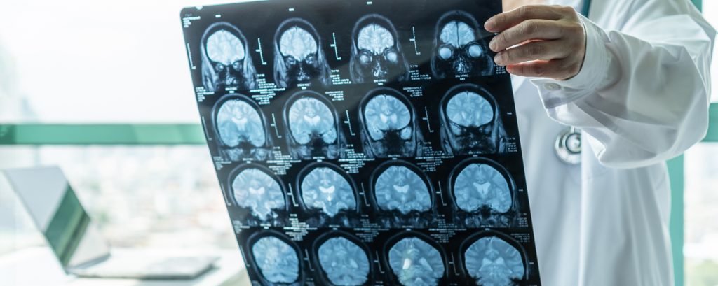 Nuove frontiere nel trattamento dell’Alzheimer  e di altre malattie neurodegenarative